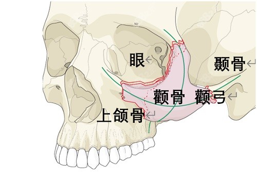 柳超医生颧骨手术实例口碑