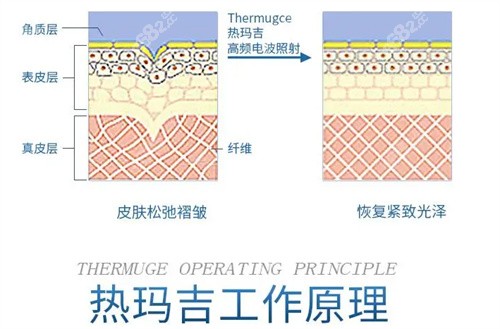 热玛吉工作原理演示图