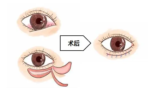 倒睫手术前后对比照片二