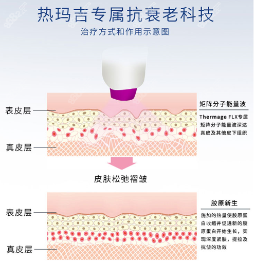 延世多仁热玛吉特点