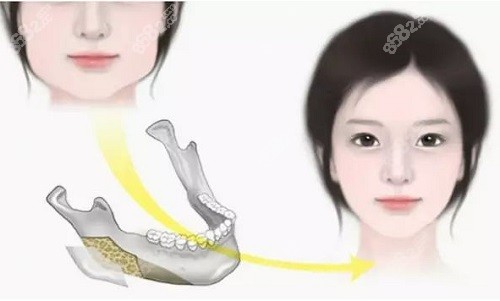 柳超医生磨骨价格实惠