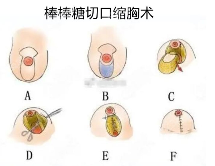 缩胸手术好的医生做缩胸手术切口图解