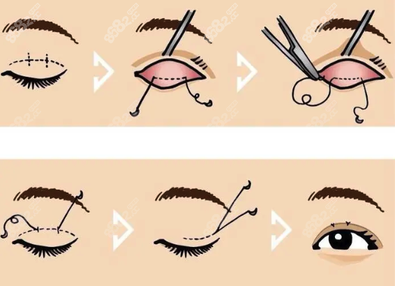 重慶華美眼綜合多少錢