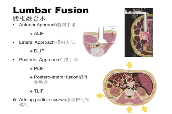 微创腰椎融合术
