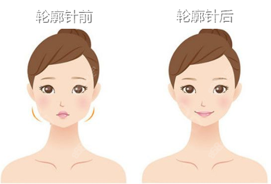 注射轮廓针改脸型对比www.8682.cc