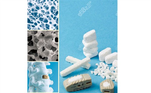 人工骨是什么材料做的