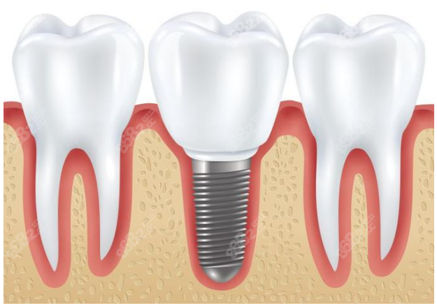 西安团圆口腔医院种植牙