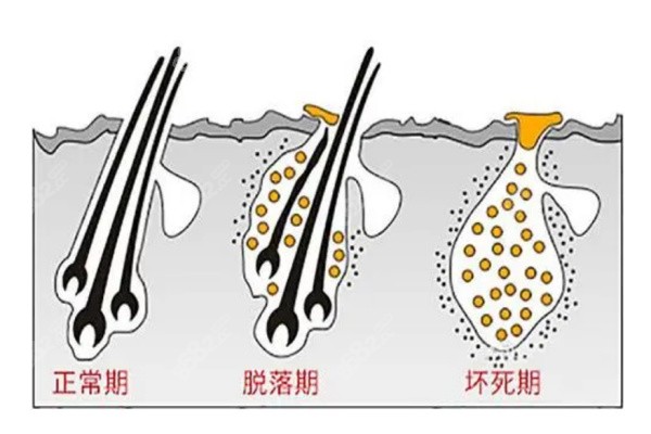 毛囊坏死