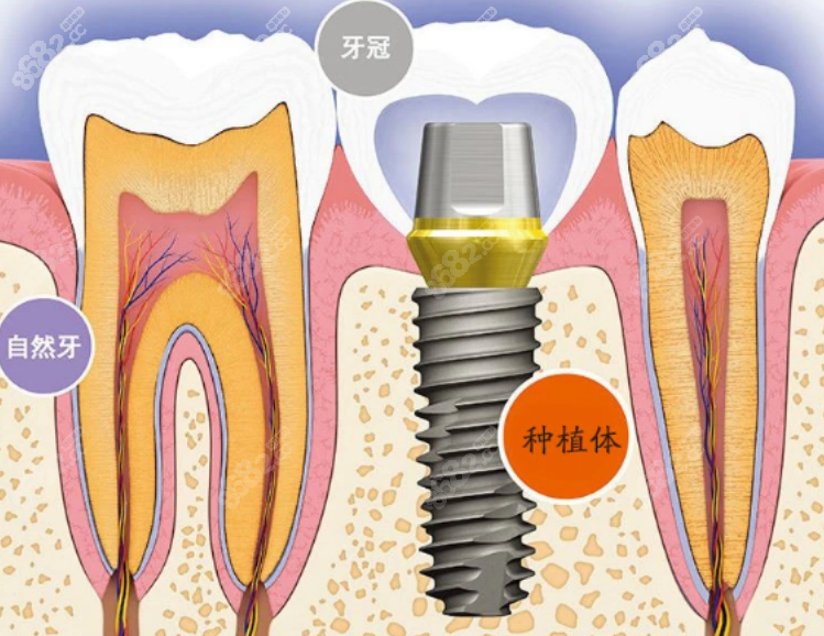 西安团圆口腔医院种植牙