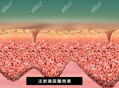 西安玻尿酸填充好的医生有谁