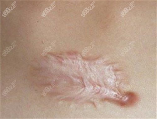 擴(kuò)張器治療疤痕成功概率是多少？