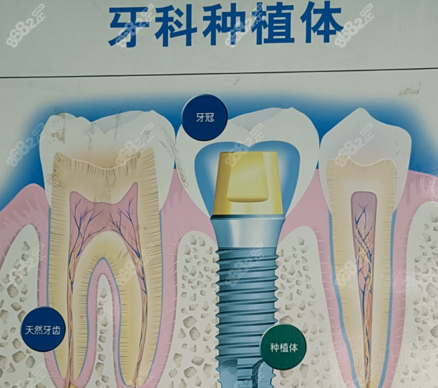 西安团圆口腔医院种植牙