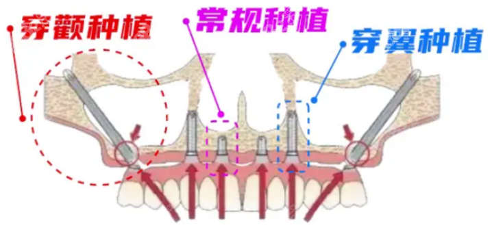 穿颧种植手术图示8682.cc