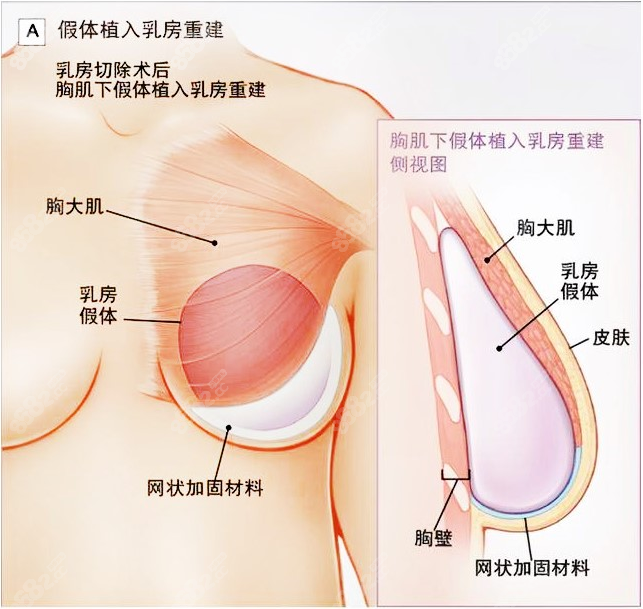 做过隆胸的谈谈感受