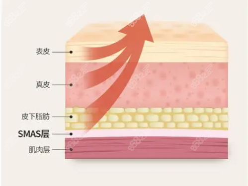 美杜莎眼袋切口中面部提升怎么做？