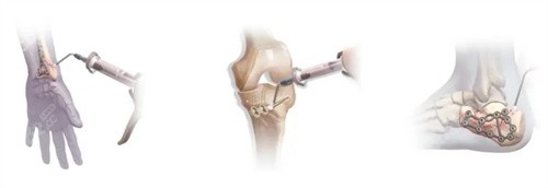 醫(yī)學(xué)領(lǐng)域的人工骨用途