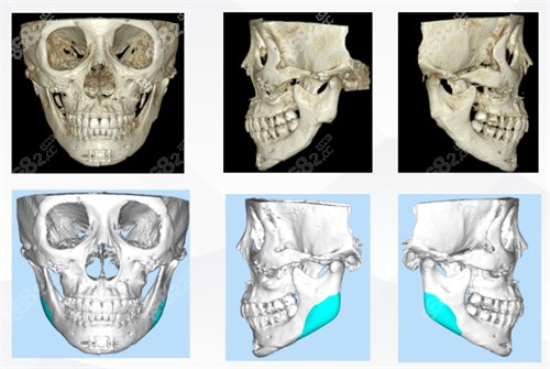 上海某醫(yī)院進(jìn)行人工骨修復(fù)下頜角手術(shù)