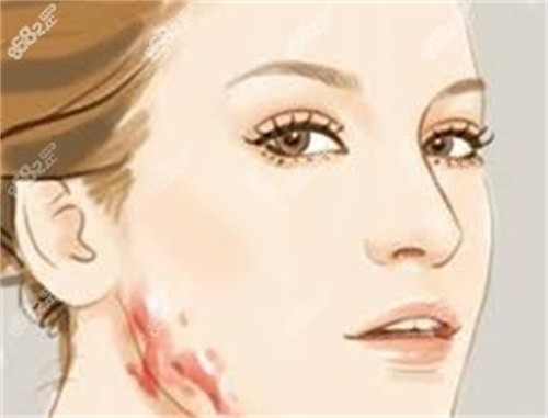 擴(kuò)張器治療疤痕花費(fèi)2萬求美者反饋