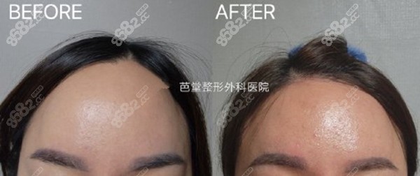 韓國(guó)芭堂縮額頭實(shí)例 韓國(guó)芭堂縮額頭實(shí)例