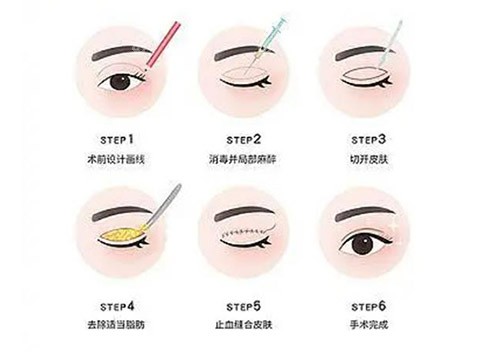 寧波藝星整形雙眼皮怎么樣