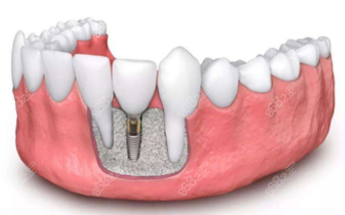 西安团圆口腔医院种植牙