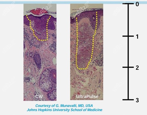 超深脈沖沖擊激光祛疤層次更深