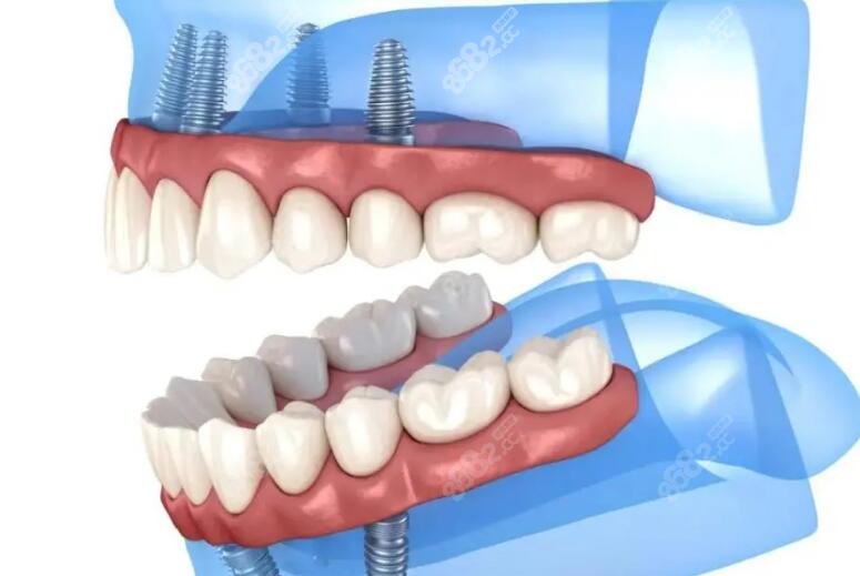 湘潭唯雅口腔半口种植牙费用