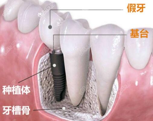 种植牙整体好还是分段式好