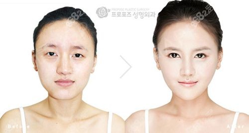 韓國propose普羅普姿整形醫(yī)院金院長做輪廓手術對比圖m.8682.cc