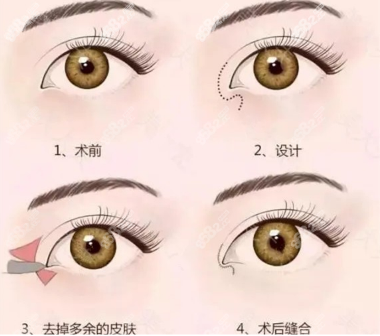 双眼皮修复手术