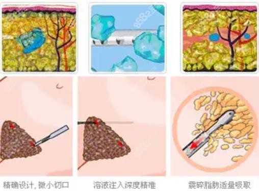 北京知音李奇军在腰腹部环吸怎么样