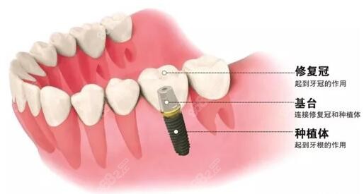 湘潭种植牙价格表www.8682.cc