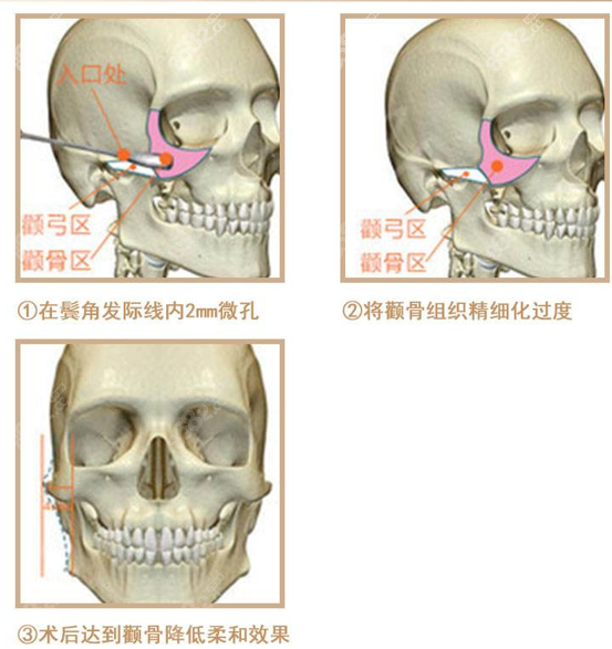 微创15分钟颧骨内推原理8682.cc