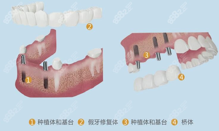 成都新桥口腔医院种牙技术强