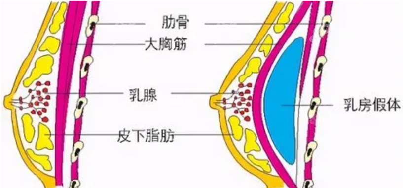 假体隆胸