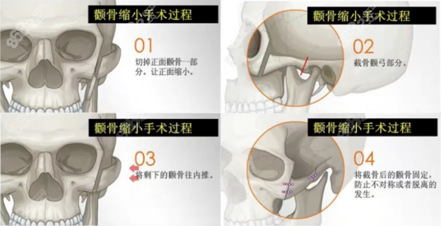 沈绍勇颧骨内推手术过程www.8682.cc