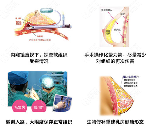 高超医生隆胸技术怎么样？成熟吗？