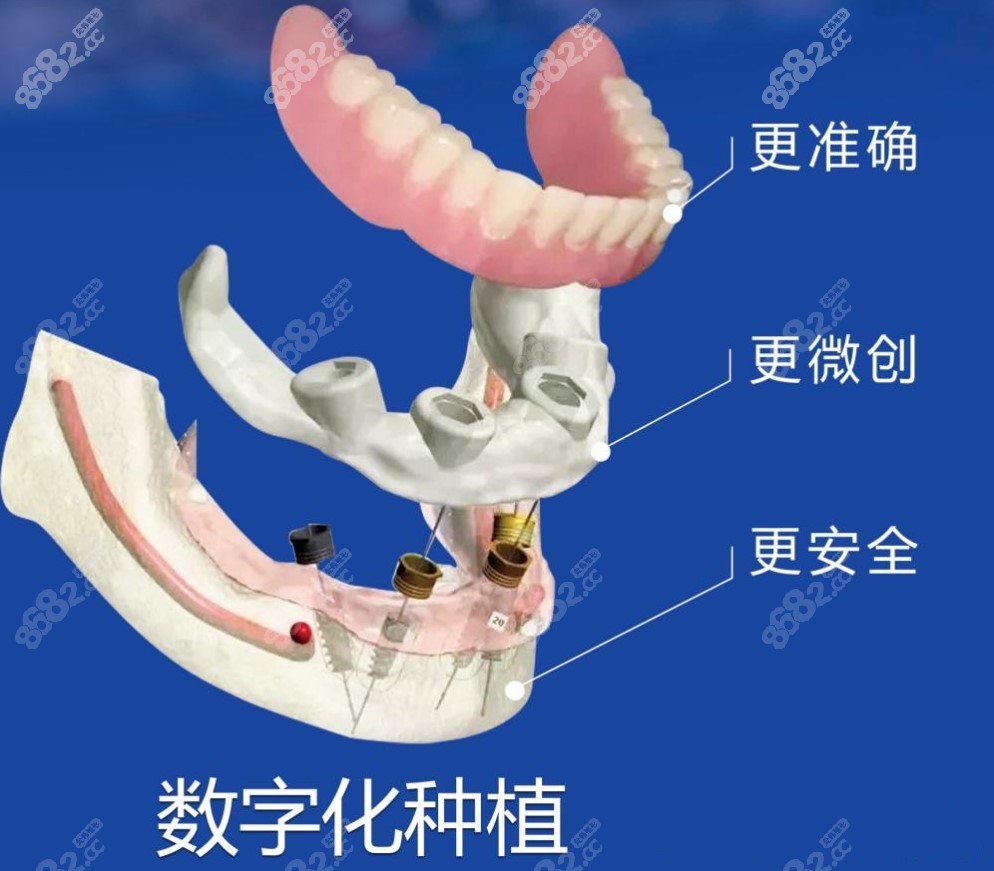 南宁柏乐口腔种植牙技术优势m.8682.cc
