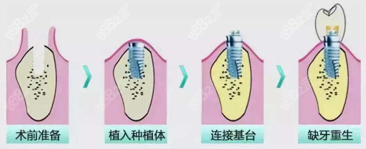 普通种植牙过程