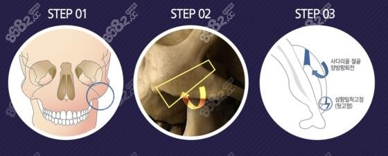 韩国FacePlus整形外科3D立体颧骨旋转术