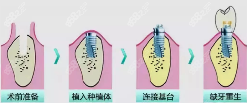 即刻种植牙步骤分析