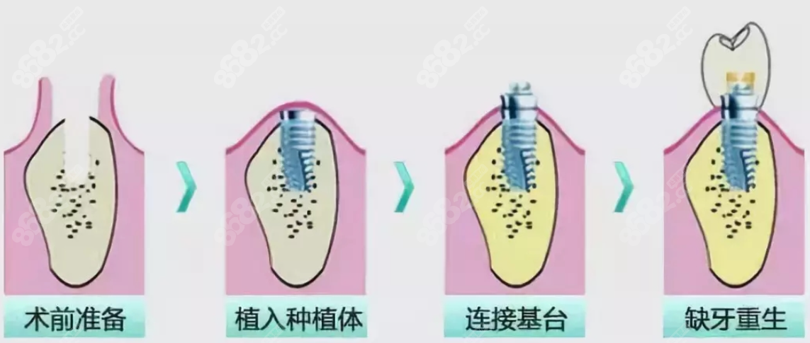 即刻种植牙流程8682.cc