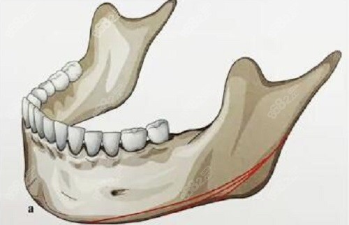 柳超医生下颌角截骨术