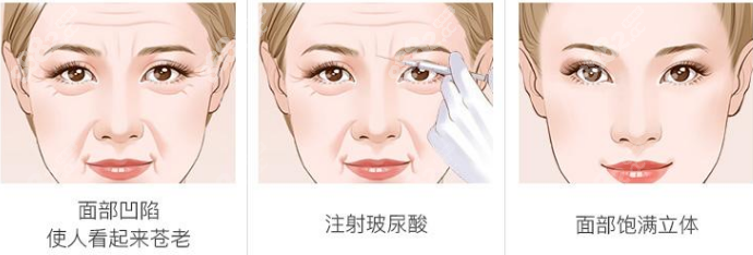 注射打造幼态脸过程www.8682.cc