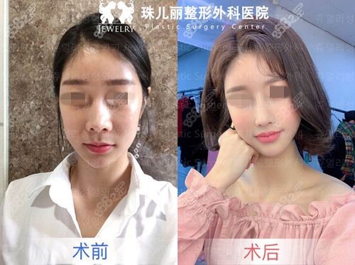 韩国珠儿丽整形外科面部填充对比