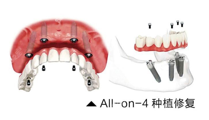 allon4种植牙
