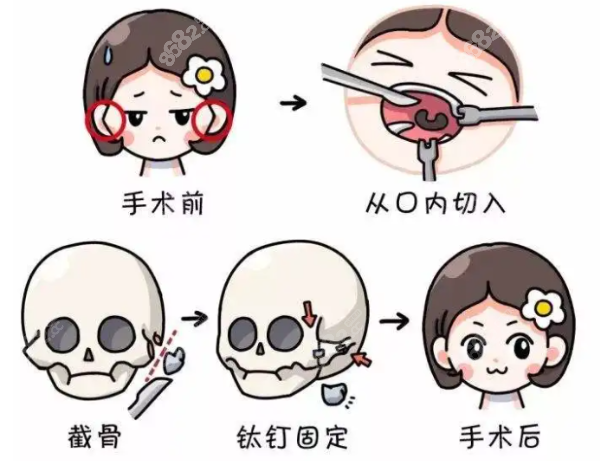颧骨内推手术过程图解