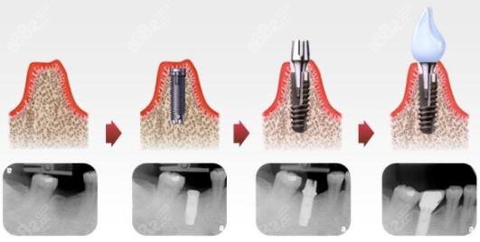 种植牙的过程步骤详解