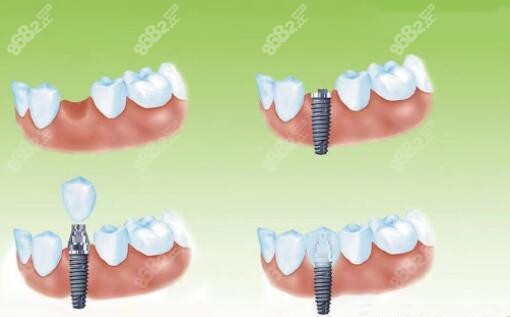 牙齿种植全过程m.8682.cc