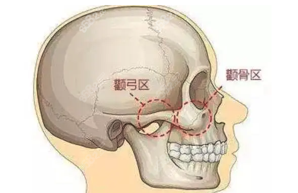 西安颧骨颧弓整形医生
